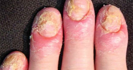 El ungüento de la psoriasis izrail comprar